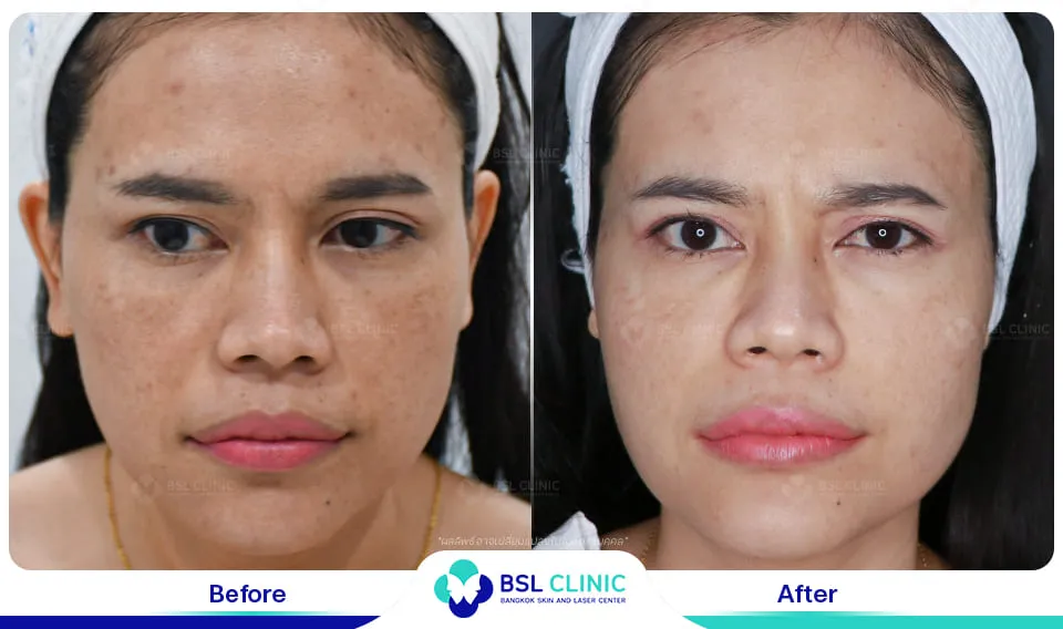 รักษาฝ้ากระ