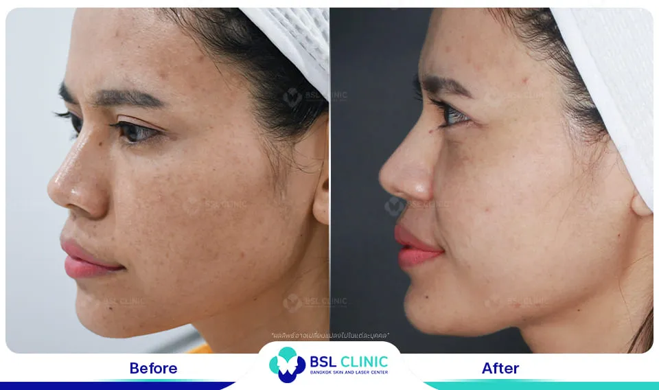 รักษาฝ้ากระ