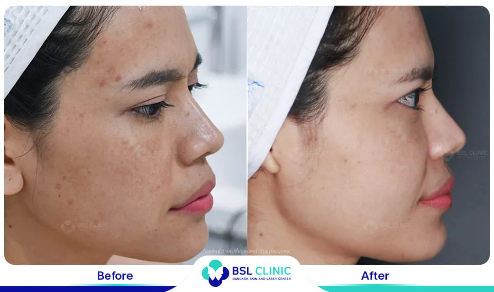 รักษาฝ้ากระ