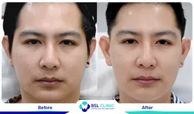 รีวิวยกกระชับปรับรูปหน้า