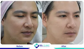 รีวิวยกกระชับปรับรูปหน้า