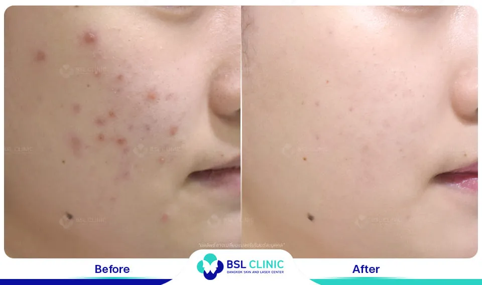 รีวิวรักษารอยแดง