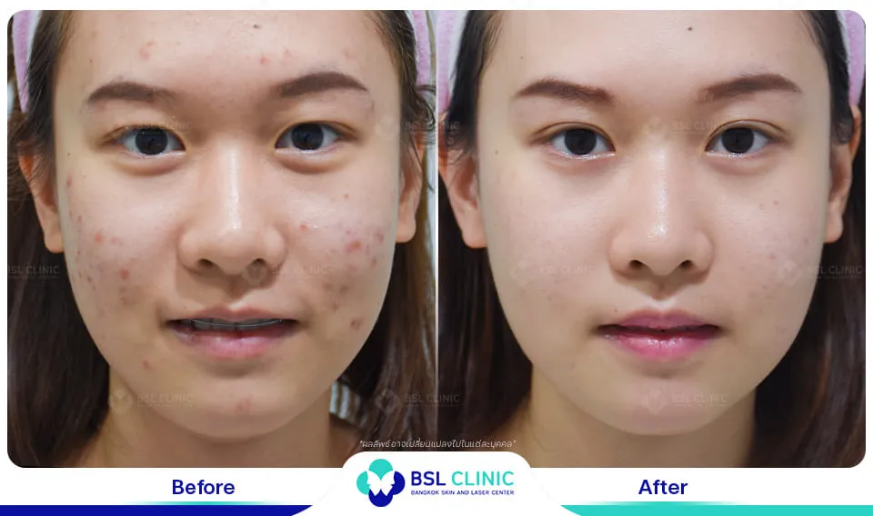 รีวิวรักษารอยแดง