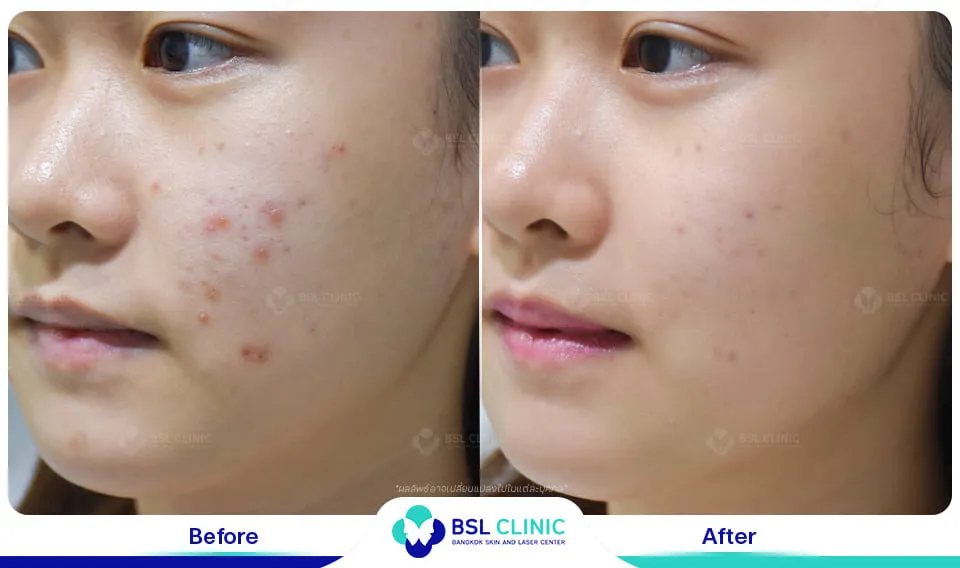 รีวิวรักษารอยแดง