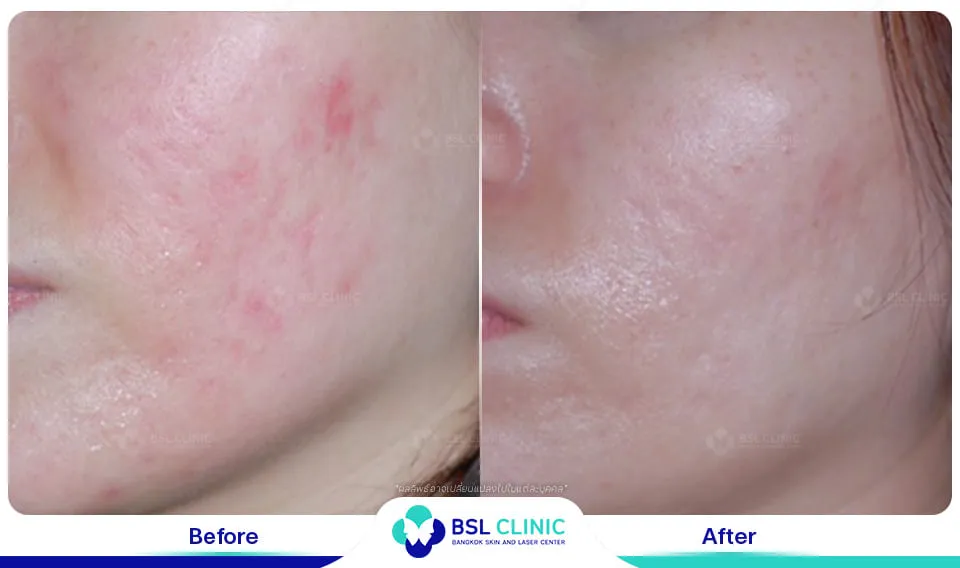 รีวิวรักษารอยแดง