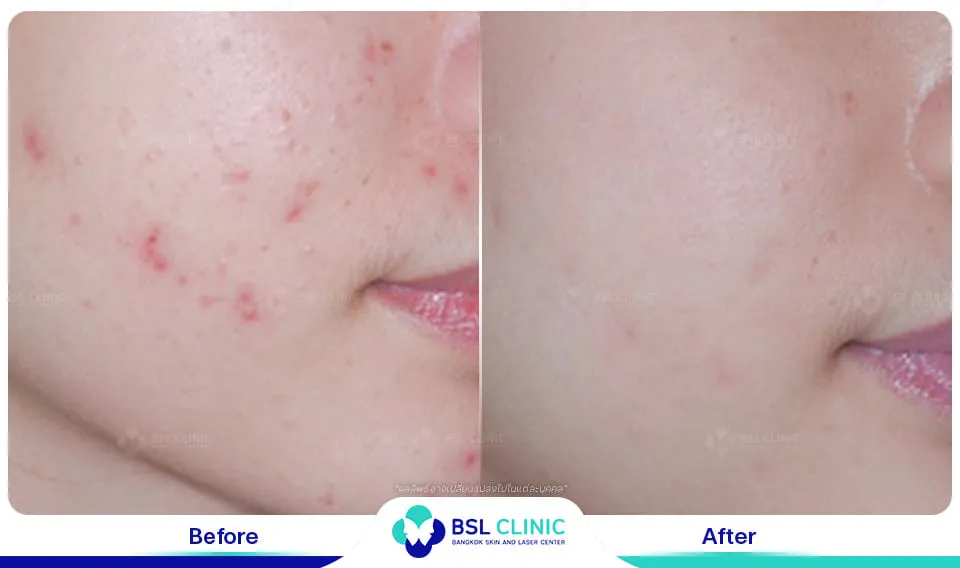 รีวิวรักษารอยแดง