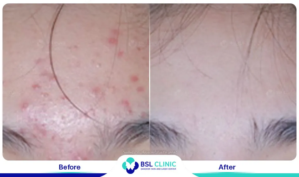 รีวิวรักษารอยแดง