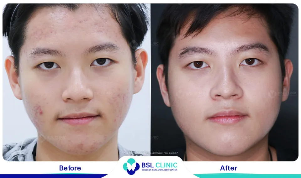 รีวิวรักษารอยแดง