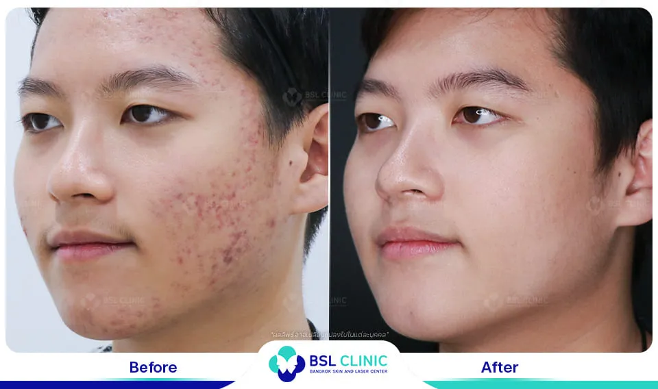 รีวิวรักษารอยแดง