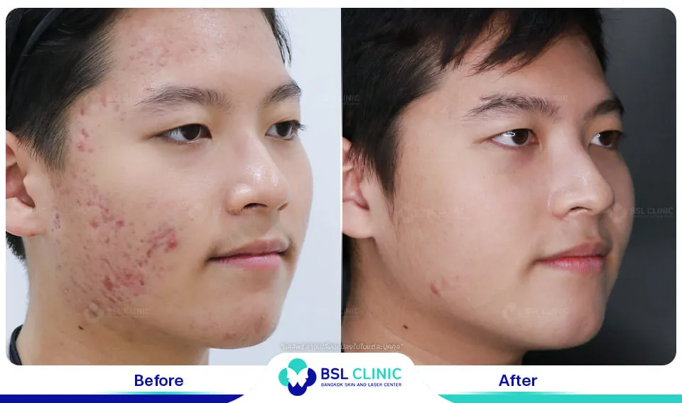 รีวิวรักษารอยแดง