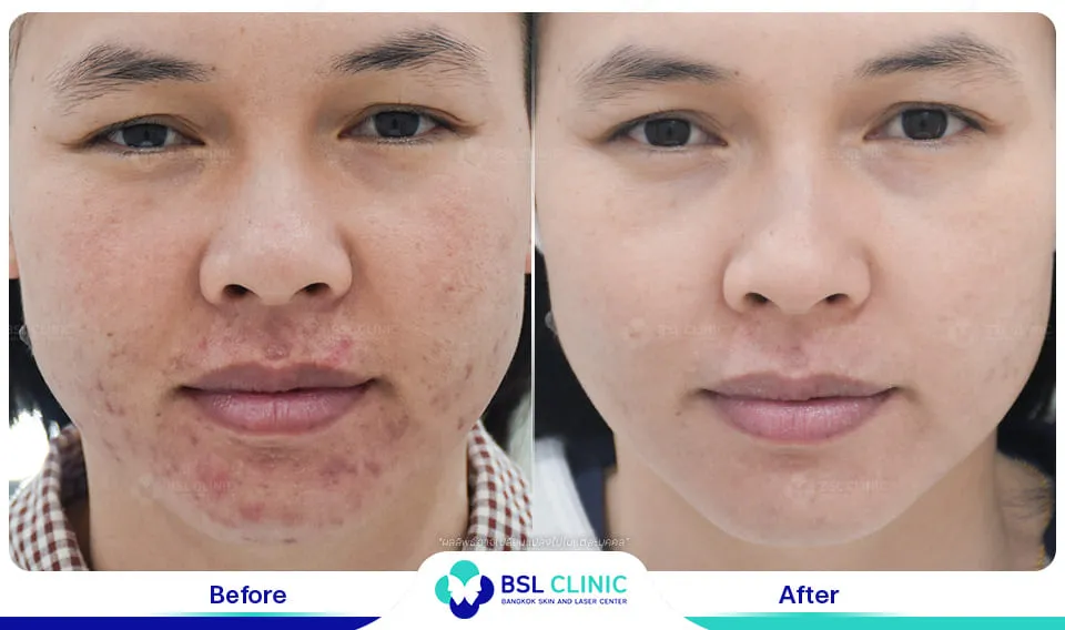 รักษารอยแดงสิว