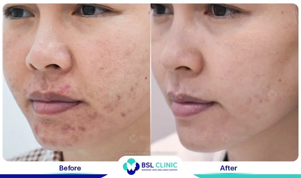 รักษารอยแดงสิว