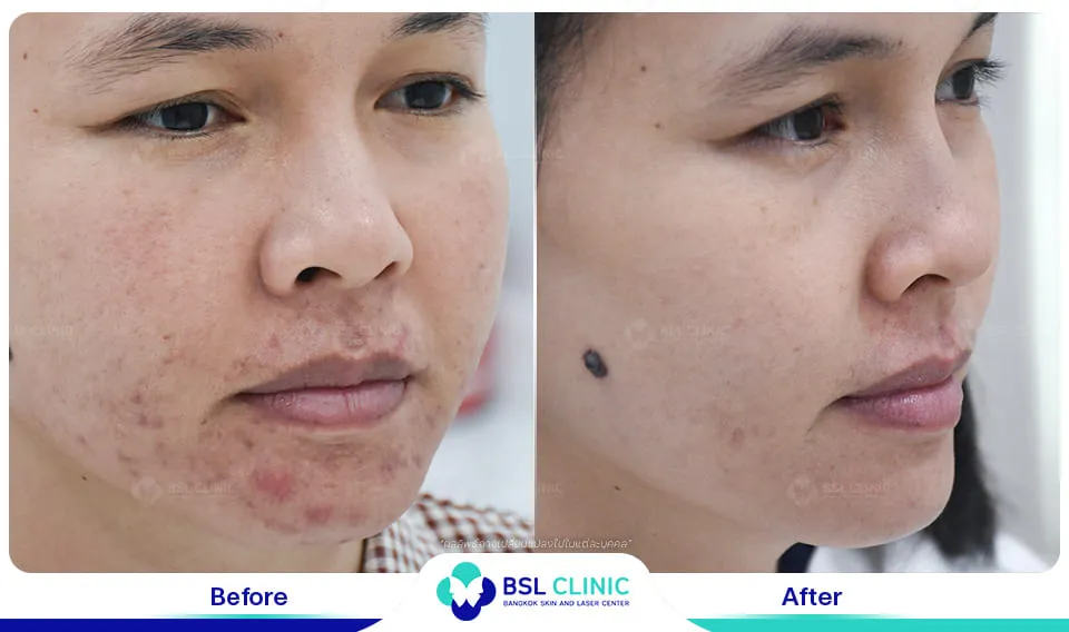 รักษารอยแดงสิว