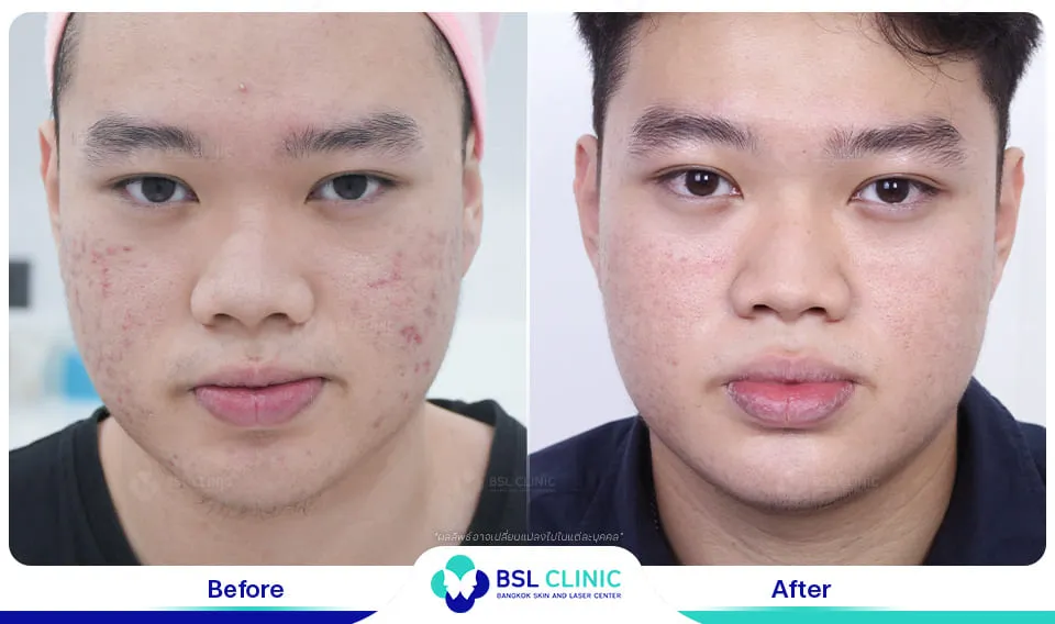 รักษารอยแดงสิว