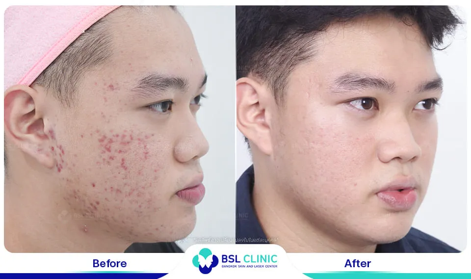 รักษารอยแดงสิว