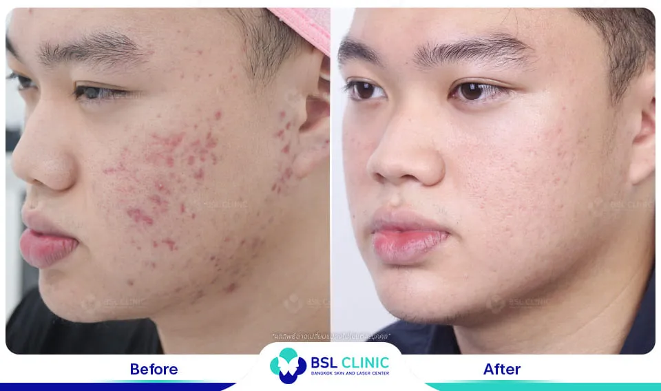 รักษารอยแดงสิว