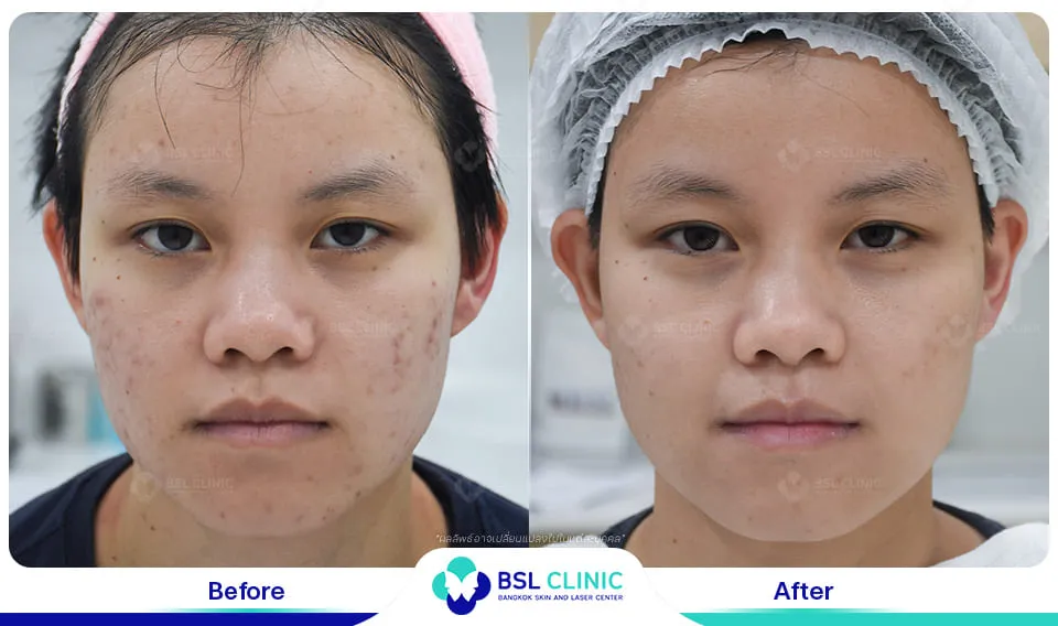 รักษารอยแดงสิว