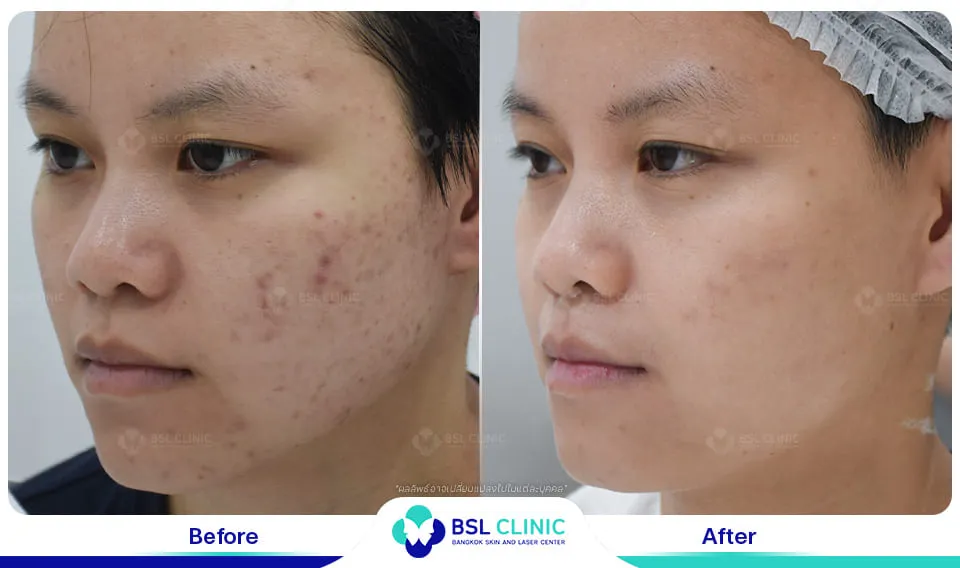 รักษารอยแดงสิว