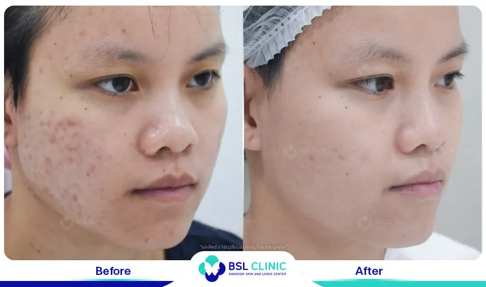 รักษารอยแดงสิว