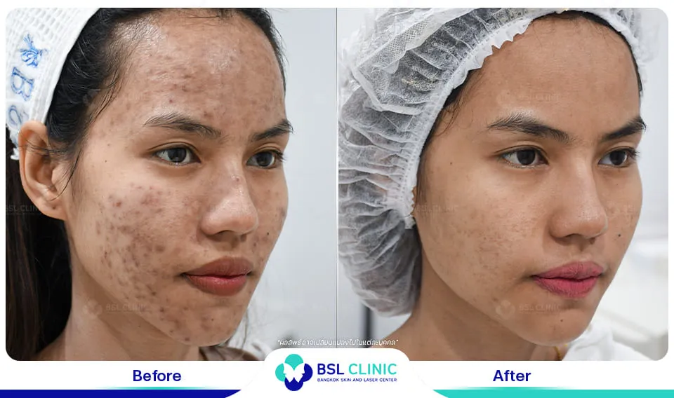 รีวิวรักษารอยดำสิว