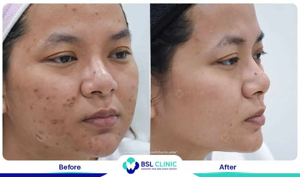 รีวิวรักษารอยดำสิว