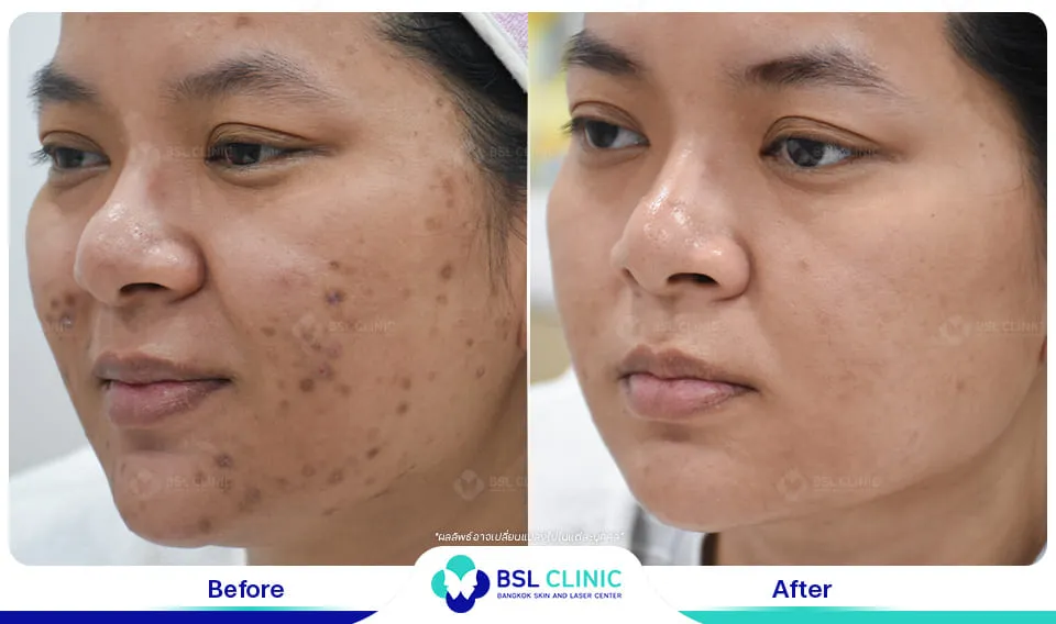 รีวิวรักษารอยดำสิว