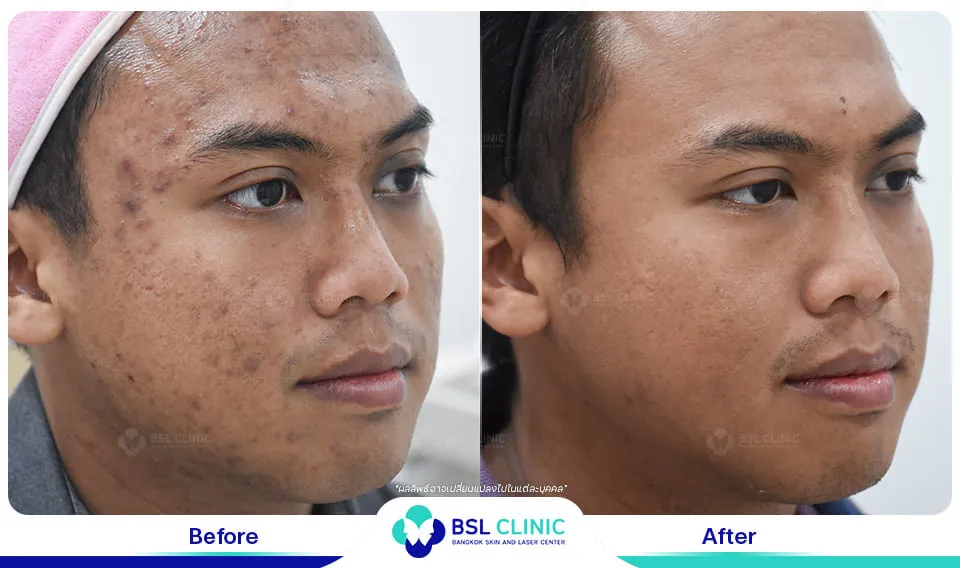 รีวิวรักษารอยดำสิว