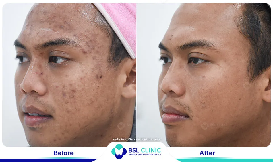 รีวิวรักษารอยดำสิว