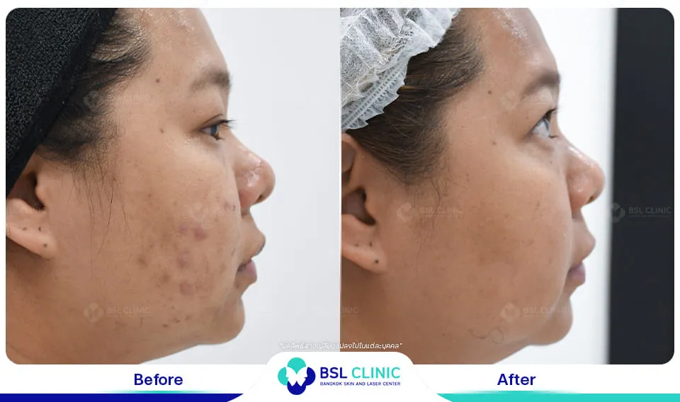 รีวิวรักษารอยดำ