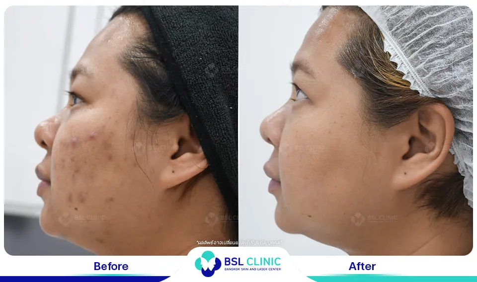 รีวิวรักษารอยดำ