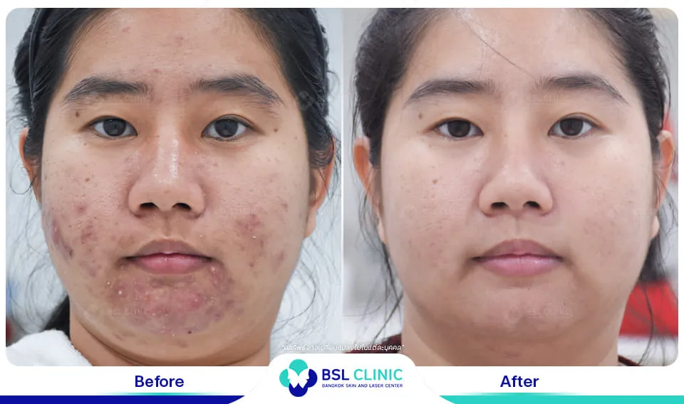 รีวิวรักษารอยดำ