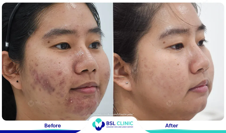 รีวิวรักษารอยดำ