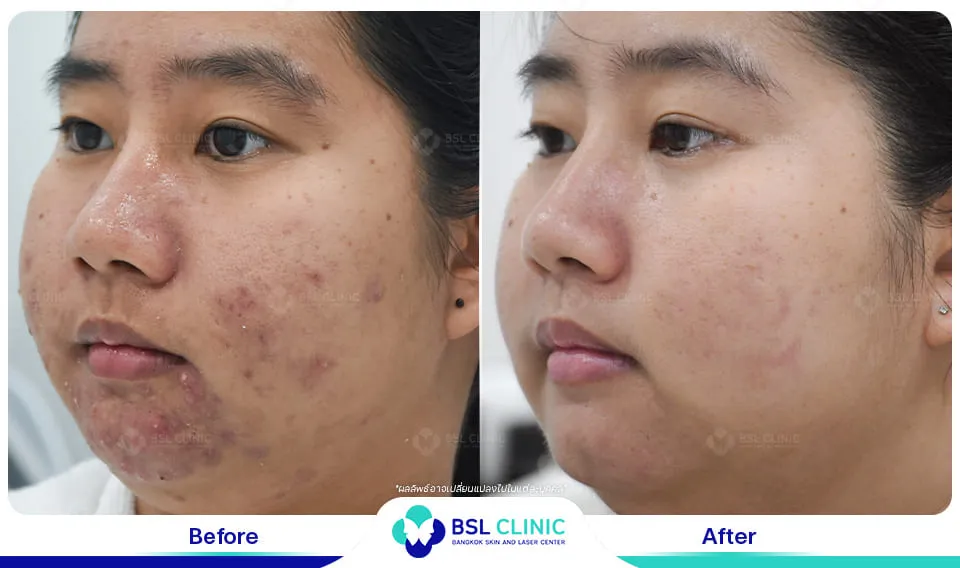 รีวิวรักษารอยดำ