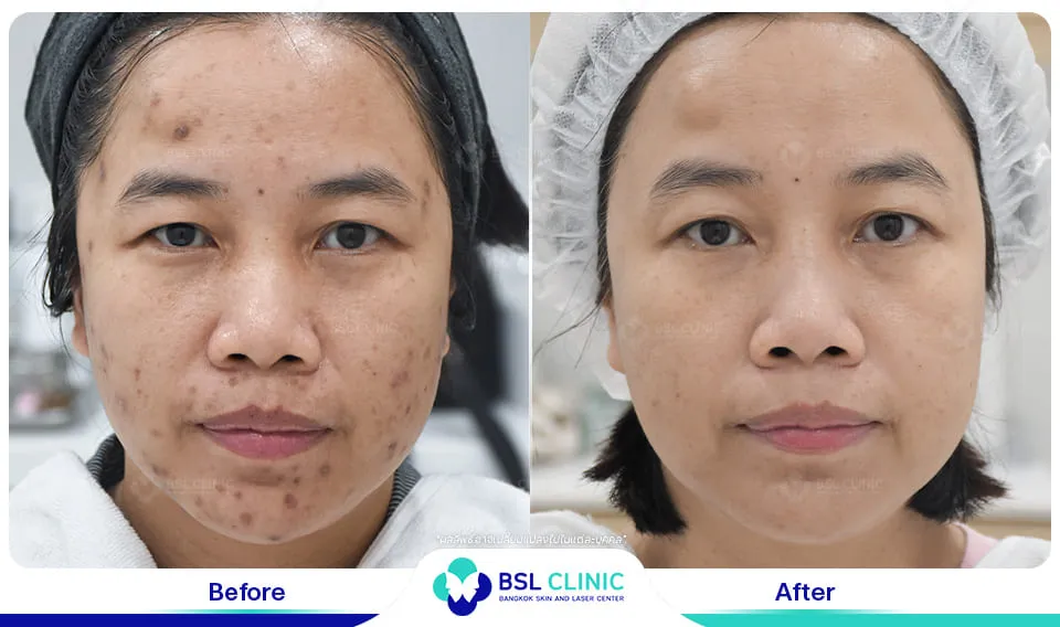 รีวิวรักษารอยดำสิว