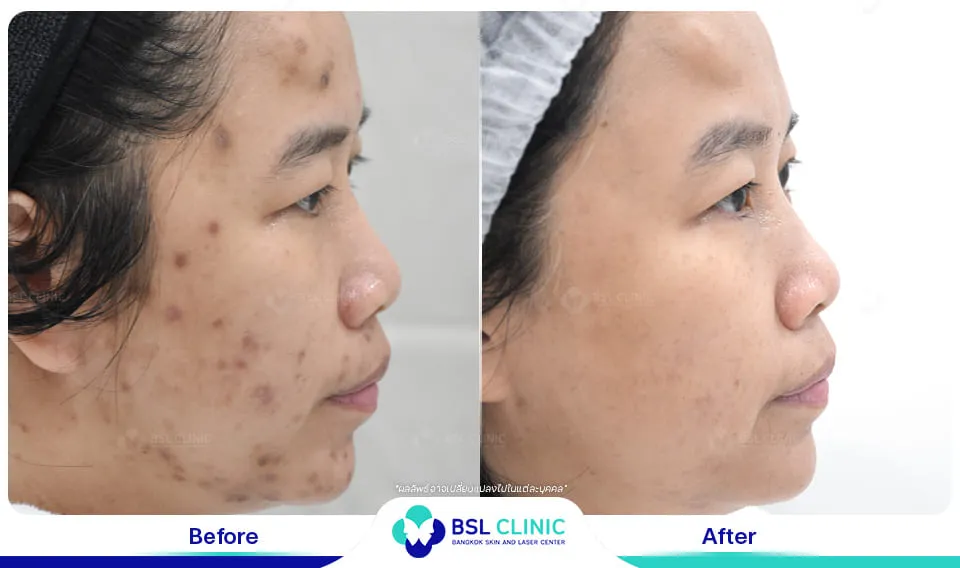 รีวิวรักษารอยดำสิว