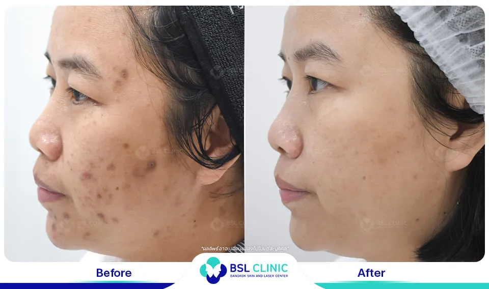 รีวิวรักษารอยดำสิว