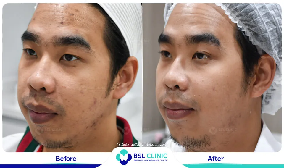 รีวิวผิวกระจ่างใส