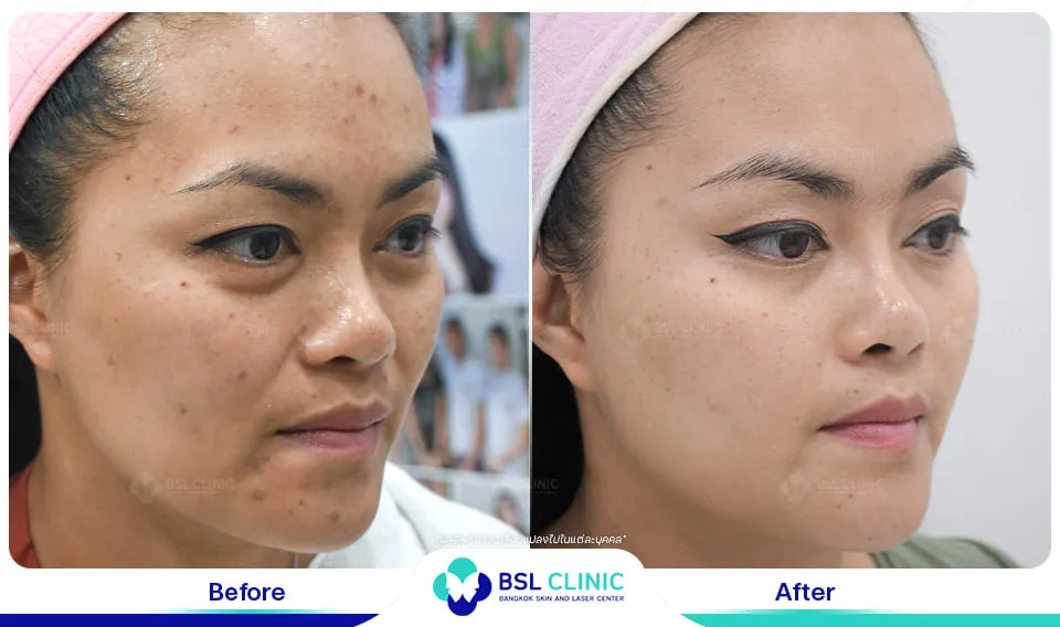 รีวิวผิวกระจ่างใส