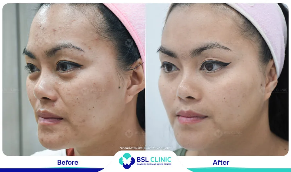 รีวิวผิวกระจ่างใส