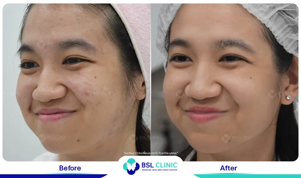 รีวิวรักษาสิว