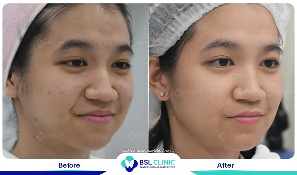 รีวิวรักษาสิว