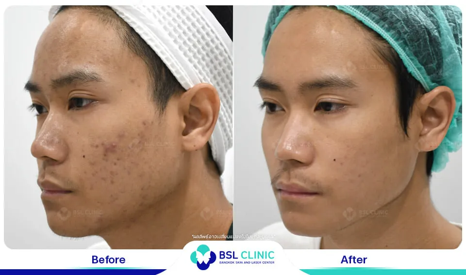 รีวิวรักษาสิว