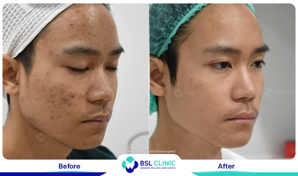 รีวิวรักษาสิว