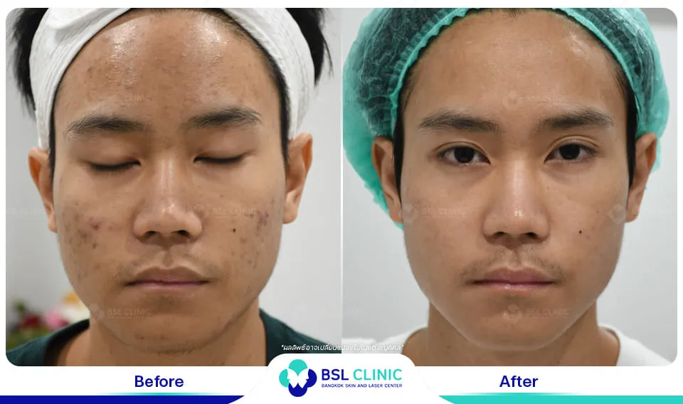 รีวิวรักษาสิว