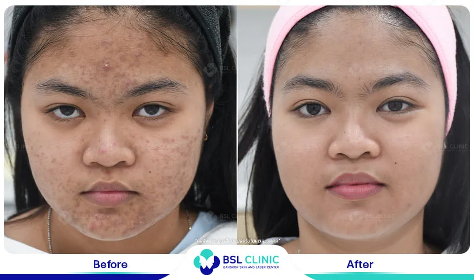 รีวิวรักษาสิว