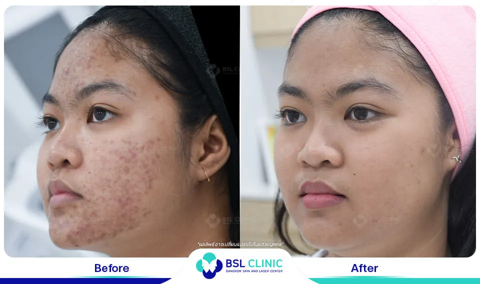 รีวิวรักษาสิว