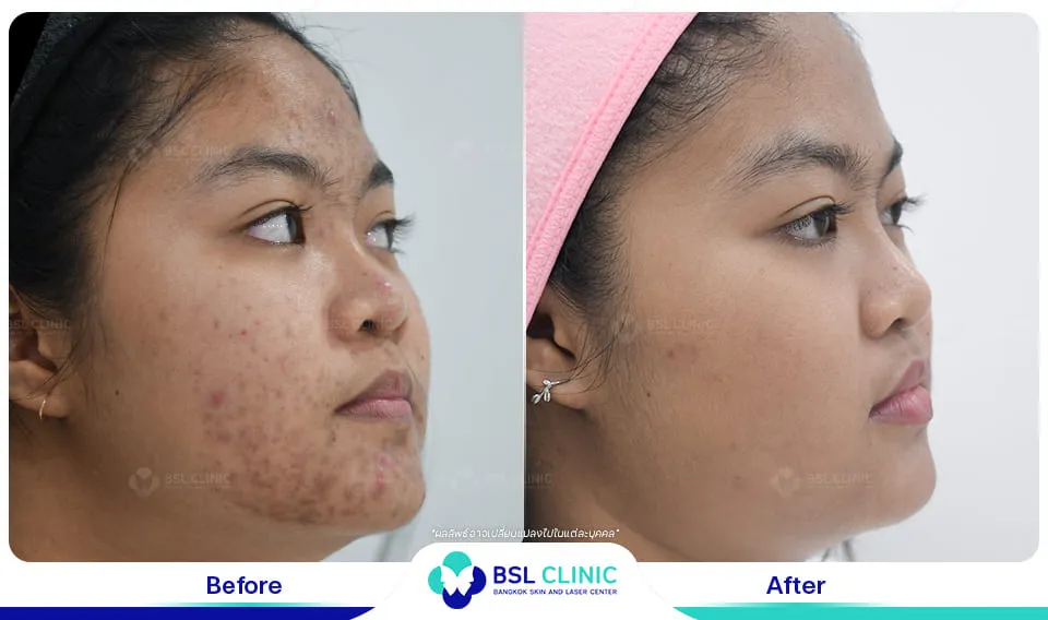 รีวิวรักษาสิว