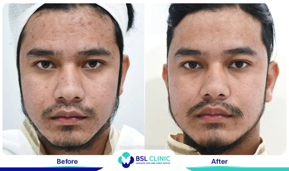 รีวิวรักษาสิว