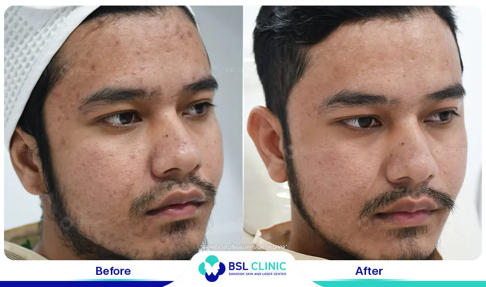 รีวิวรักษาสิว