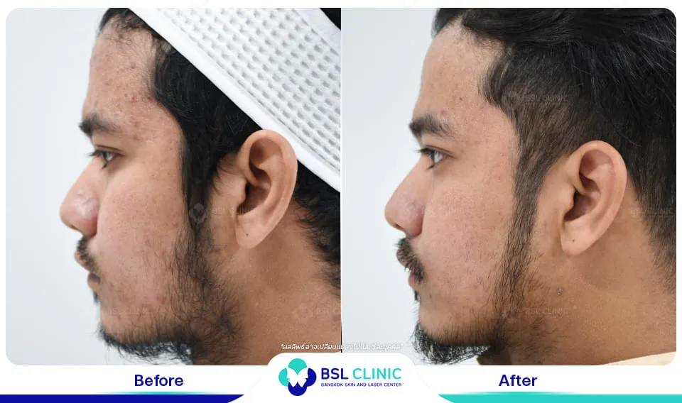 รีวิวรักษาสิว